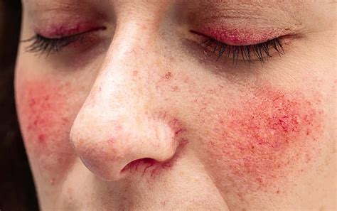 Skin Redness, Rosacea - Treatment Photos, Causes, In Malaysia