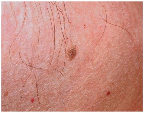 Black spots on my scrotum