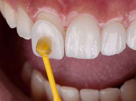 dental veeners milton keynes stunning results  team