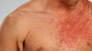 What Are the Causes And Symptoms of Cutaneous Candidiasis? | Skin Disease Causes, Symptoms And ...