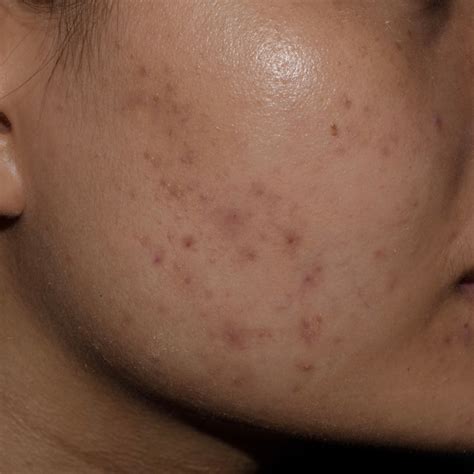 Acne | bergenderm