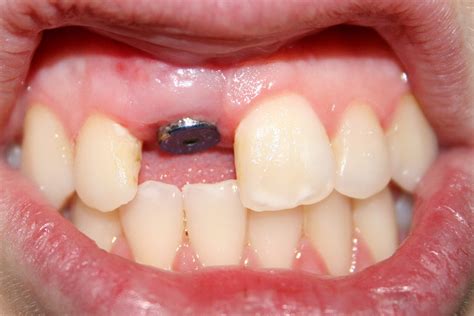 Забни импланти | Dentizar