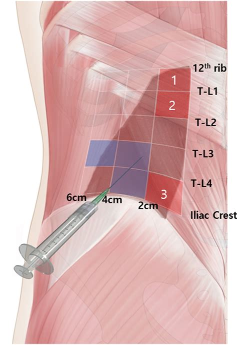 Iliac Crest Muscle Pain
