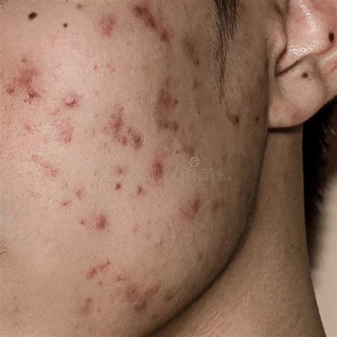 Hormonal Acne Neck