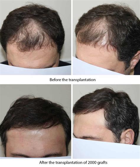 2000 Transplantat FUT Haartransplantation