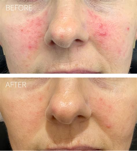Capillaries Skin