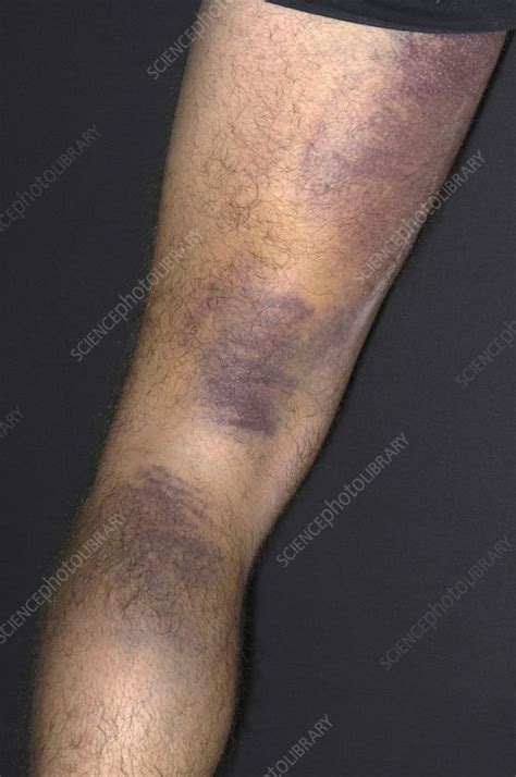 Bruised leg - Stock Image - M330/1701 - Science Photo Library