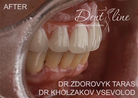 Цены на имплантацию зубов, Киев ️ Поставить имплант 2024