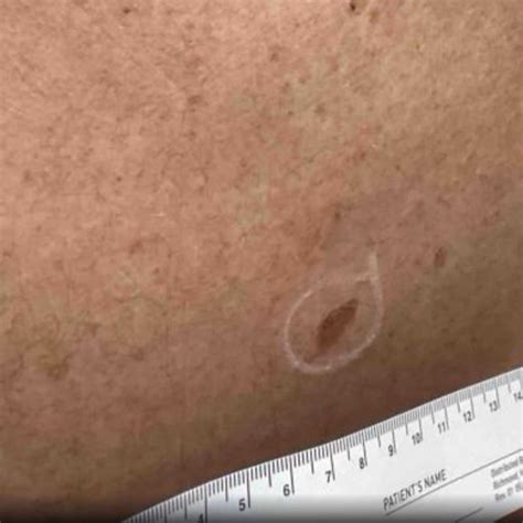Can you die from skin cancer? | Cynthia Golomb, MD | Dermatology Boutique