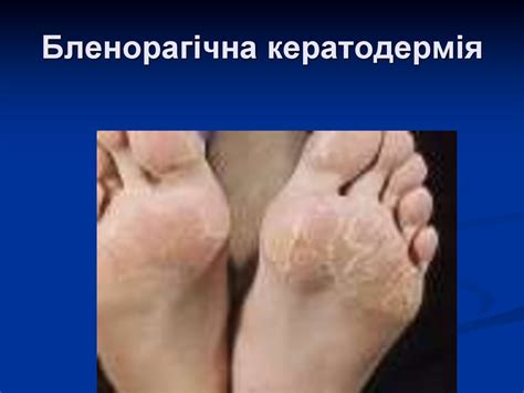 Реактивний артрит - online presentation
