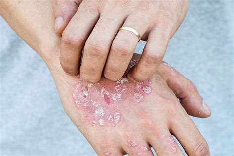 Plaque Psoriasis On Hands