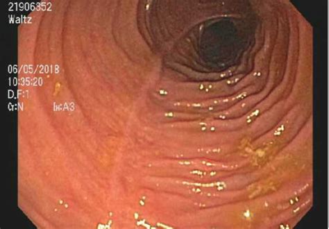 pouchoscopy dr james church