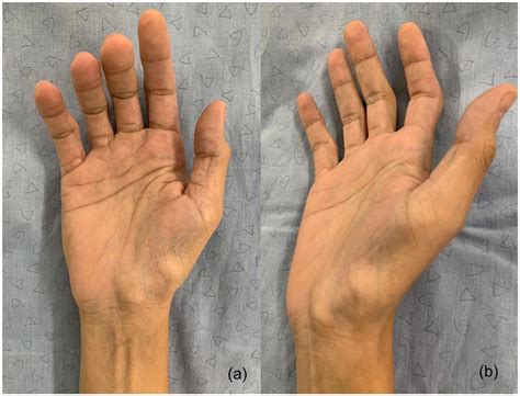 Abductor Pollicis Brevis Atrophy