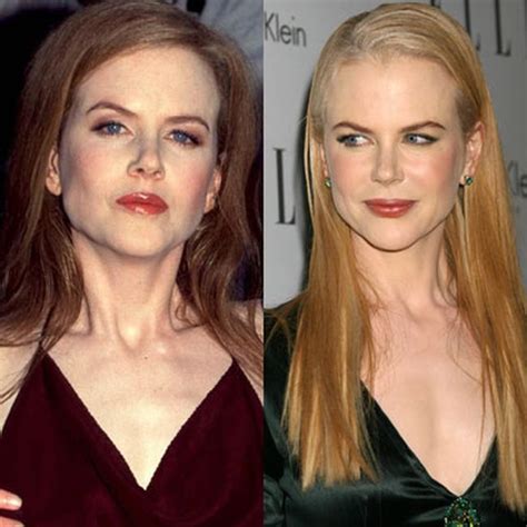 Nicole Kidman Plastic Surgery 2024 - Kanya Juline