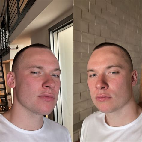 Osteoma Forehead