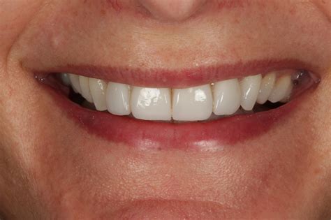 veneers nova smiles