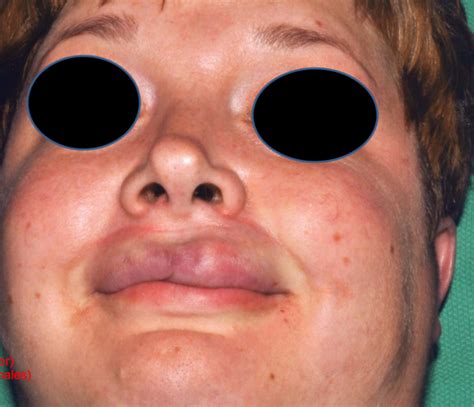 exam  lesions  surface flashcards quizlet