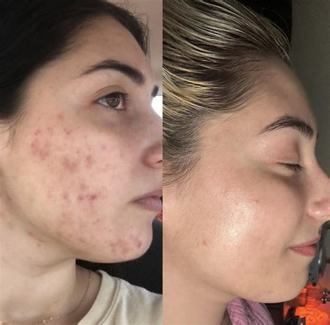 See the Amazing Transformation: Invisalign Before and After Stories to Inspire You 1