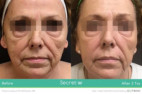 Secret Radio Frequency Microneedling | Dartmouth Dermatology