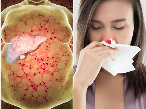Fatty Liver Disease