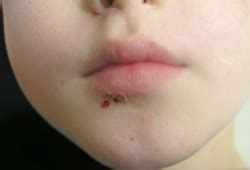 Impetigo - Symptoms, diagnosis and treatment | BMJ Best Practice
