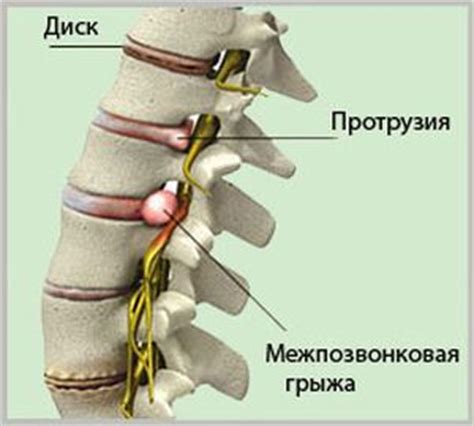 Лечение межпозвоночной грыжи