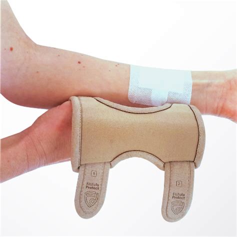 Protector for newly made AV fistulas – Fistula Protect