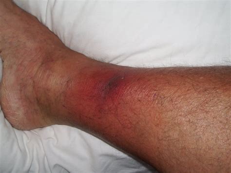 mrsa  nose    candice cogar blog