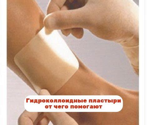 Гидроколлоидные пластыри от мозолей, ран, пролежней, как применять