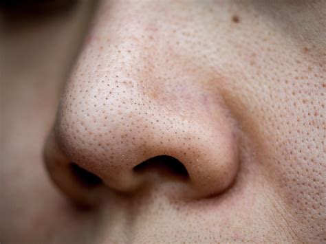 Why You Shouldn’t Attempt Removing Blackheads Yourself