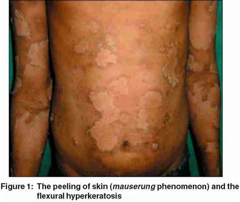 discovered ichthyosis bullosa  siemens mrvq
