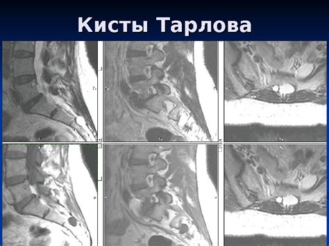 Периневральная киста позвоночника на уровне s2 s3 - лечение