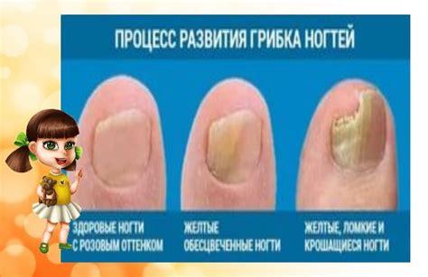 Лечение ногтей дома: спасаем свой великолепный маникюр