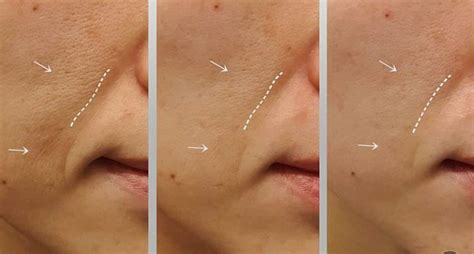I Used Volufiline For 30 Days And Here Are The Results, 57% OFF