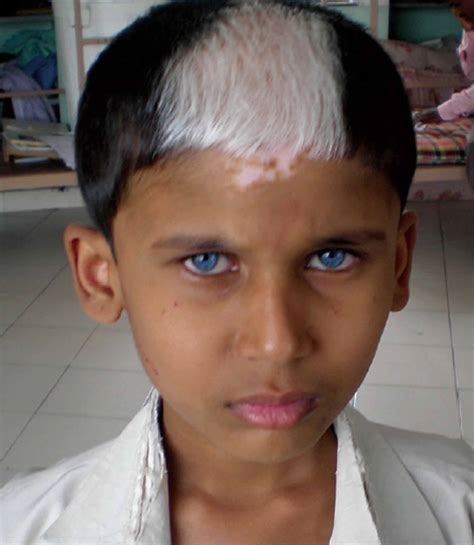 Sindrome De Waardenburg Fotos - LIBRAIN