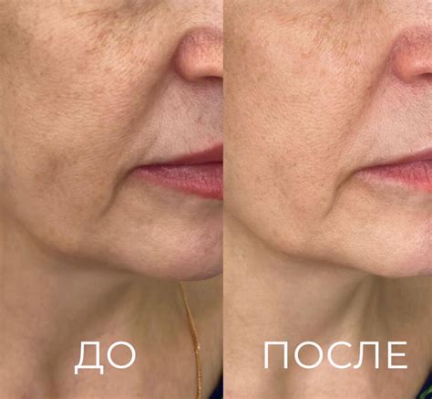 Микроигольчатый RF-лифтинг (РФ Лифтинг) в Симферополе