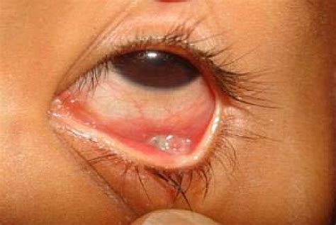 Conjunctival Foreign Body
