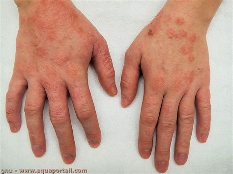 dermatite definition  explications