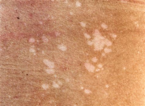 White Patches On Face Vitamin Deficiency Treatment