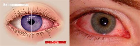 Як лікувати кон'юнктивіт у дорослих?