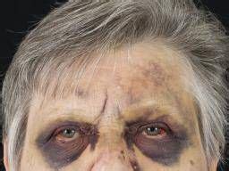 Raccoon eyes: Causes and treatments