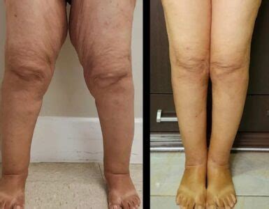 Lipedema Antes E Depois Academia - Lipedema: Antes e depois em 20 Fotos – Antes da Fama