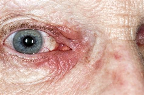 Periorbital dermatitis - Stock Image - C047/8466 - Science Photo Library