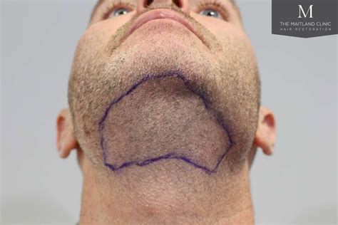 Body Hair Transplant - alliance4hair.com