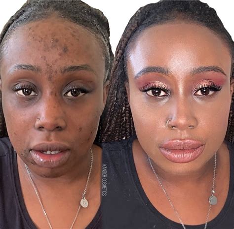 KANDOR | LUXURY HIGH PIGMENT CAMOUFLAGE MAKEUP CONCEALER FOR VITILIGO ...