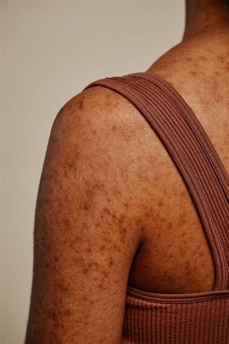 Detail Shot of Female Body Skin Texture and Acne Scars on Back and ...
