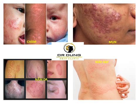 BS Dung Da liễu BMT – Sống Vui Khi Bạn Khỏe & Đẹp