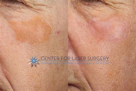 Xanthelasma Removal | Washington, DC | Center for Laser Surgery