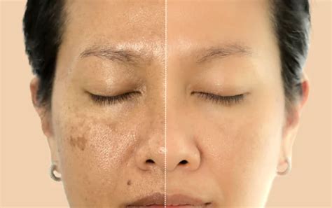 sun damage treatments  billericay skin experts