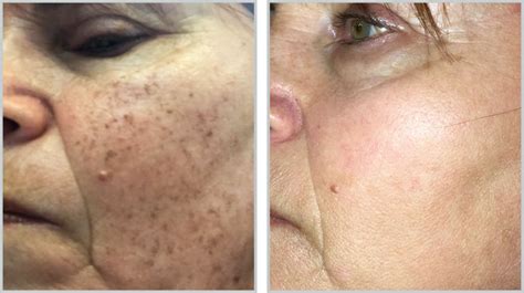 Forever Young BBL |Tyte Medispa Millbrook,NY